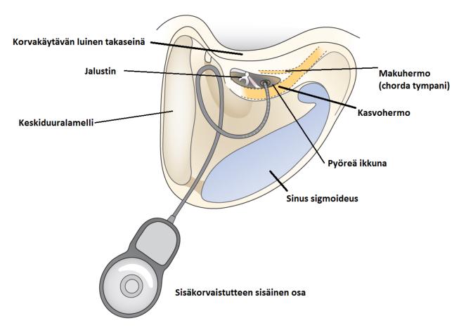 Liitekuva 1. Sisäkorvaistuteleikkaus. Tavallisesti sisäkorvaleikkaus aloitetaan tekemällä mastoidektomia eli poraamalla auki korvan takana sijaitseva korvalokerosto.