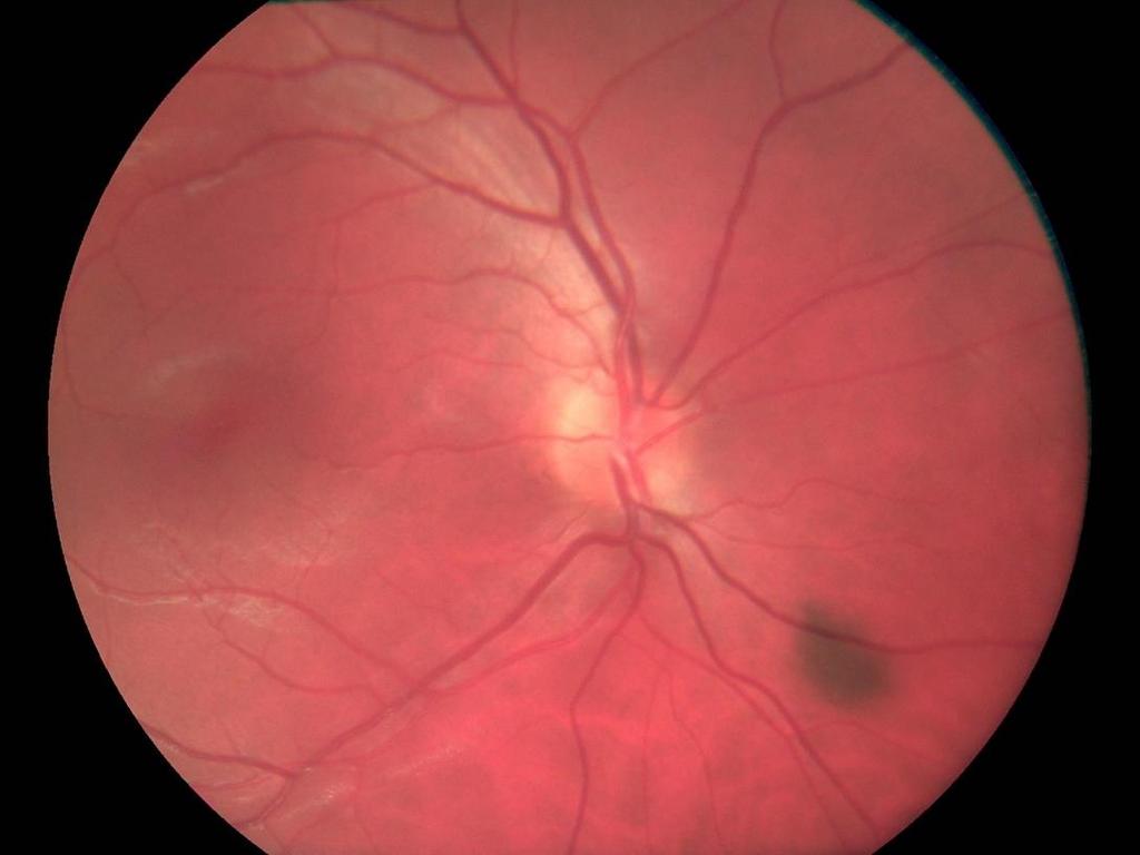 (potilas X01) Kuva 4: Optomed Smartscope
