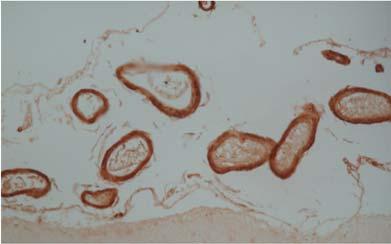 amyloid (A ) tunnettu vuodesta 1984 Amyloid Prekursor