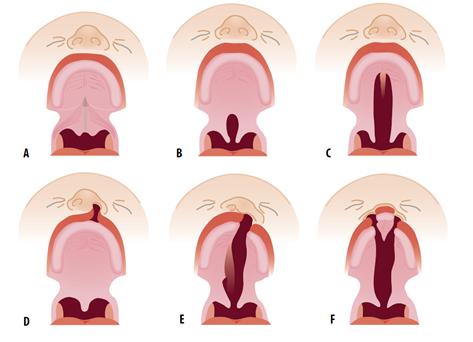 11 min voidaan tuntea kovan suulaen etureunassa pieni lovi. Halkio voi myös kuultaa limakalvon alla suulaen keskiviivassa. Piilosuulakihalkioon liittyy usein kaksiosainen uvula.