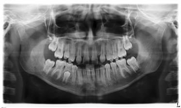 5 Käyttö Sirona Dental Systems GmbH 5.4 Panorama- ja purentakappale-/bitewingkuvaus 5.4.1.