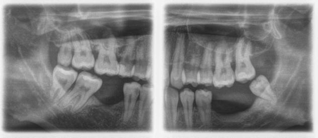 5 Käyttö Sirona Dental Systems GmbH 5.4 Panorama- ja purentakappale-/bitewingkuvaus 5.4.1.