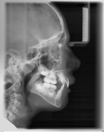 5 Käyttö Sirona Dental Systems GmbH 5.8 Kaukoröntgenkuva 5.8.1.3 C3 Kuva, lateraalinen Tässä kuvaustekniikassa röntgenkuvassa näkyy nenätuessa oleva metalliskaala.