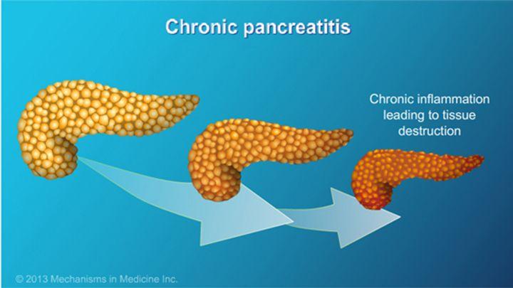 Krooninen pankreatiitti Keskeistä tyypillinen anamneesi Anamneesi Selkään säteilevä ylävatsakipu, johon mahdollisesti liittyy pahoinvointia ja oksennuksia, laihtuminen, keltaisuus Endokriinisen ja