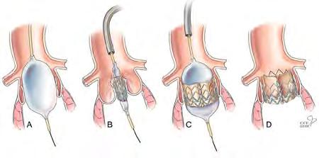 Aorttaläpän ahtauma on yleinen, hoidettavissa oleva vajaatoiminnan syy vanhuksilla Partner Cohort B: Perkutaaninen aorttaläpän asennus (TAVI)