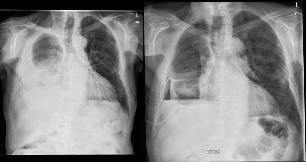 Trapped lung Eri syistä tulleen pleuranesteen vuoksi keuhko on mennyt kasaan Pleuran pintaan fibriiniä arpea - kiinnikkeitä Keuhko ei