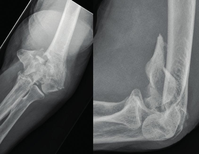 Kuva 1. Preoperatiivinen rtg-kuva.