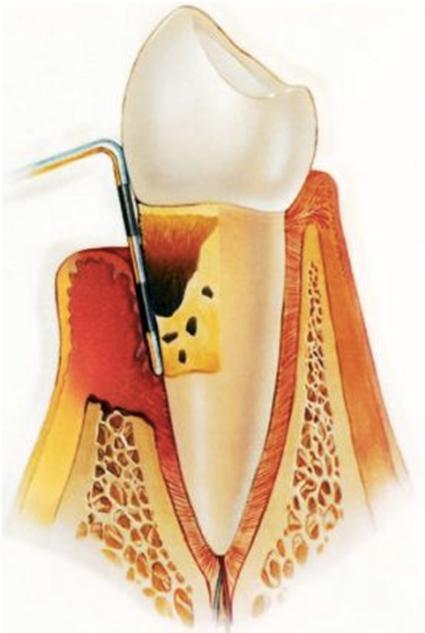 Hampaan kiinnityskudossairaudet Terveys 2000 tutkimus (yli 30- vuotiaat): Ientulehdusta 74 %:lla Syventyneitä ( 4 mm) ientaskuja 64 %:lla Syviä (