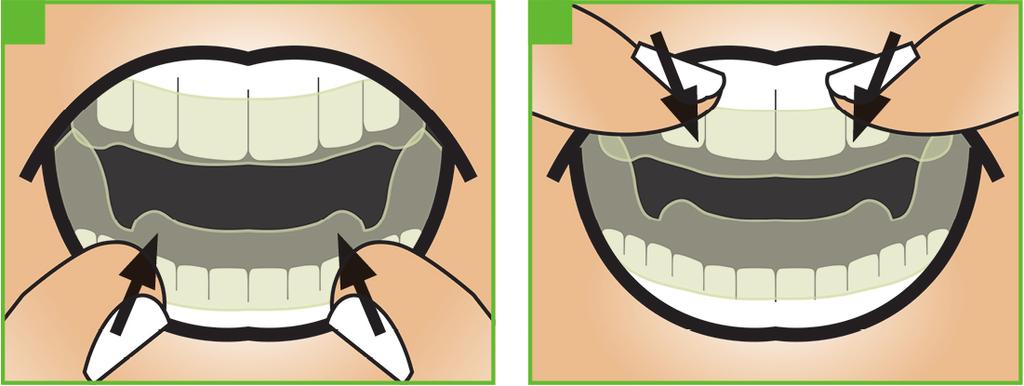 Hoitokiskon irrotus Hoitokiskon pitäisi irrota hampaista vain vähäistä voimaa käyttäen.
