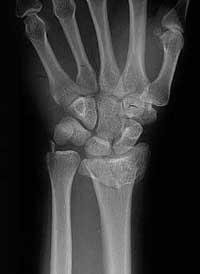 1999;10(3):214-21; Ismael ym. Osteoporos. Int.