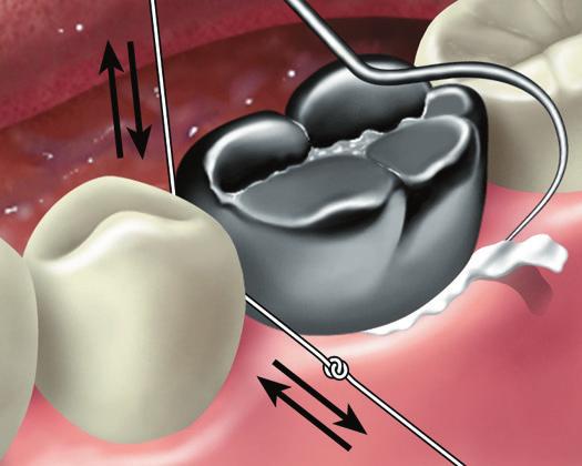 3M ESPE Teräskruunut Kun teräskruunu aiotaan asettaa molaariin, jossa karies ulottuu ienrajan alapuolelle, pitää hammas ensin paikata hampaan alkuperäisen muodon palauttamiseksi.