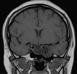 Magneettikuvassa paljastui kookas näköhermoristeystä ja corpus callosumia painava makroadenooma (A). Prolaktiinipitoisuus oli suurentunut arvoon 233 000 mu/l (viiteväli 50 500 mu/l).