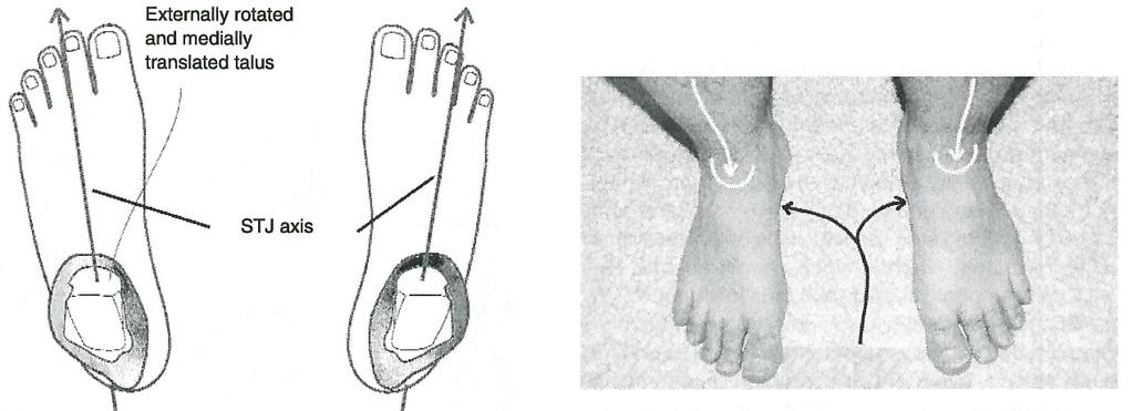 63 etupuolella (kuva 31). Yleensä lateraalisen liikeakselin omaavalle jalkaterälle on taipumus korkeampaan mediaaliseen pitkittäiskaareen ja sitä havainnollistetaan pes cavus -tyypin jalkana.