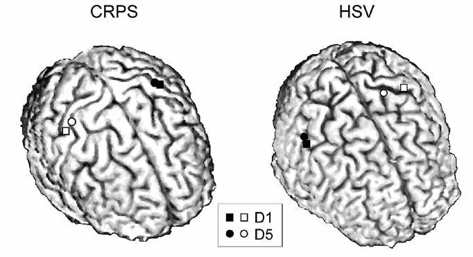 KATSAUS CRPS HSV KUVA 4. Peukalon (D1, neliöt) ja pikkusormen (D5, pallot) edustusalueet tuntoaivokuorella kahdella potilaalla, jotka kärsivät kroonisesta kivusta yläraajan alueella.