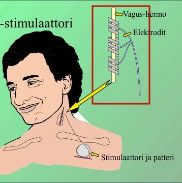 Vagushermostimulaattori patteri vasemman rintalihaksen alle stimulaatioelektrodi kierretään spiraaliksi vasemman palleahermon ympärille stimulaatio aktivoi useita aivorungon/väliaivojen tumakkeita,