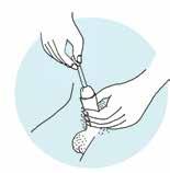 5. Vedä esinahka taakse. Pidä penistä mahaa vasten niin, että virtsaputki suoristuu kunnolla. Älä purista virtsaputkea liikaa, koska tällöin katetrin asettaminen voi vaikeutua.