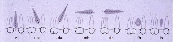 Puhkeamattoman hampaan luokittelu Kallistumat: V=Vertikaalinen MA=Mesioangulaarinen DA=Distoangulaarinen MH=Mesiohorisontaalinen DH=Distohorisontaalinen