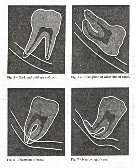 Tarvittaessa tehdään lisätutkimuksia Panoraamatomografiassa: hampaan sijainnin määrittämiseksi, hermon läheisyyden takia, juurten muodon, poskiontelon