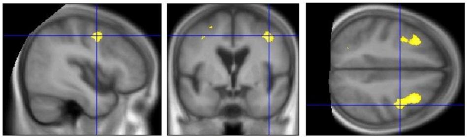 1) β.15 (p<.1) Brain derived neurotrophic factor (BDNF): a marker of cognitive functioning?