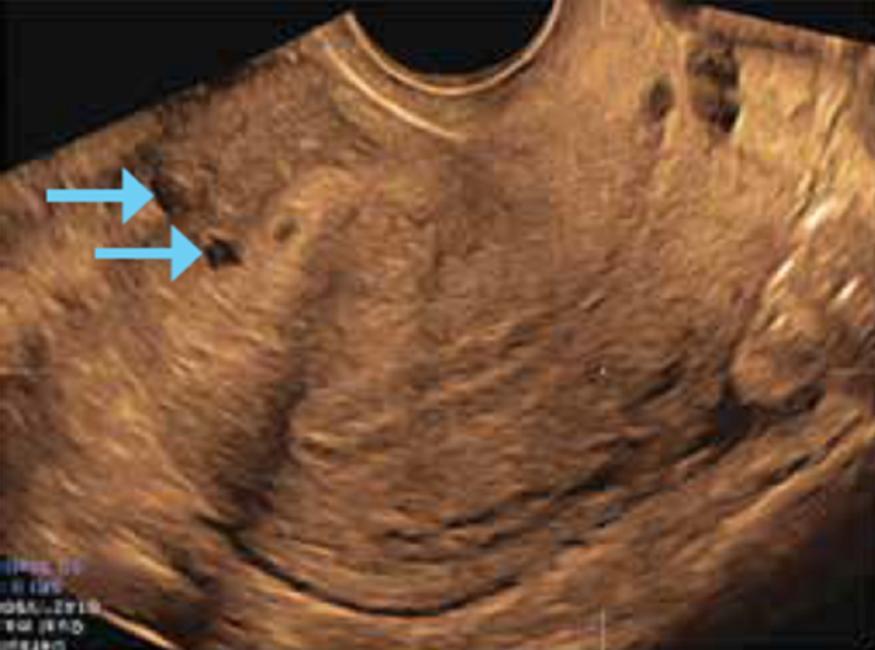 AUB-A (adenomyosis) Tavallinen, hyvänlaatuinen Oppikirjojen mukaan 40+