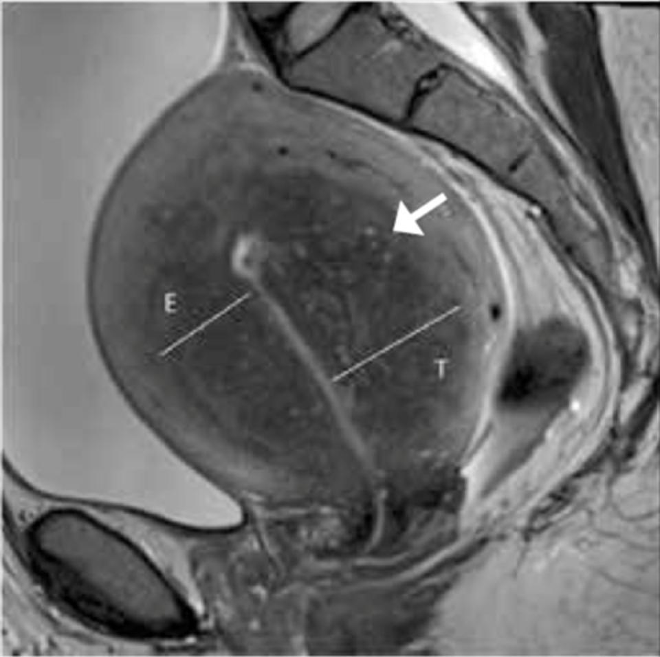 kuva kuvantaminen (UÄ, MRI) Histologia Hoito oireen mukainen Lääkehoito /