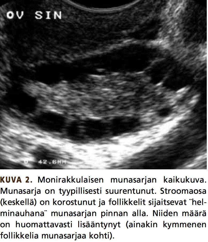 AUB-O (ovulatory) Epäsäännöllinen ja arvaamaton vuoto Usein ovulaatiohäiriö Oireina amenorrea epäsäännölliset vuodot HMB (tyypillisesti pitkittynyt vuoto) Häiriytynyt ovuaatio ja puuttuva