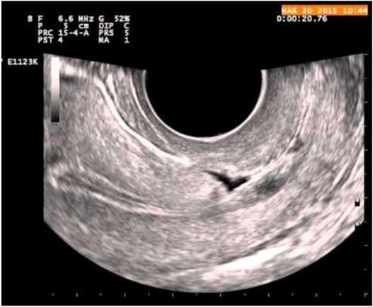 AUB-I and AUB-N AUB-I (iatrogenic) Mm lääkityksiin liittyvä Verenohennuslääkkeet (kupari)kierukka Mielialalääkkeet Gynekologiseen hormonihoitoon liittyvä BTB Ehkäisytablettien