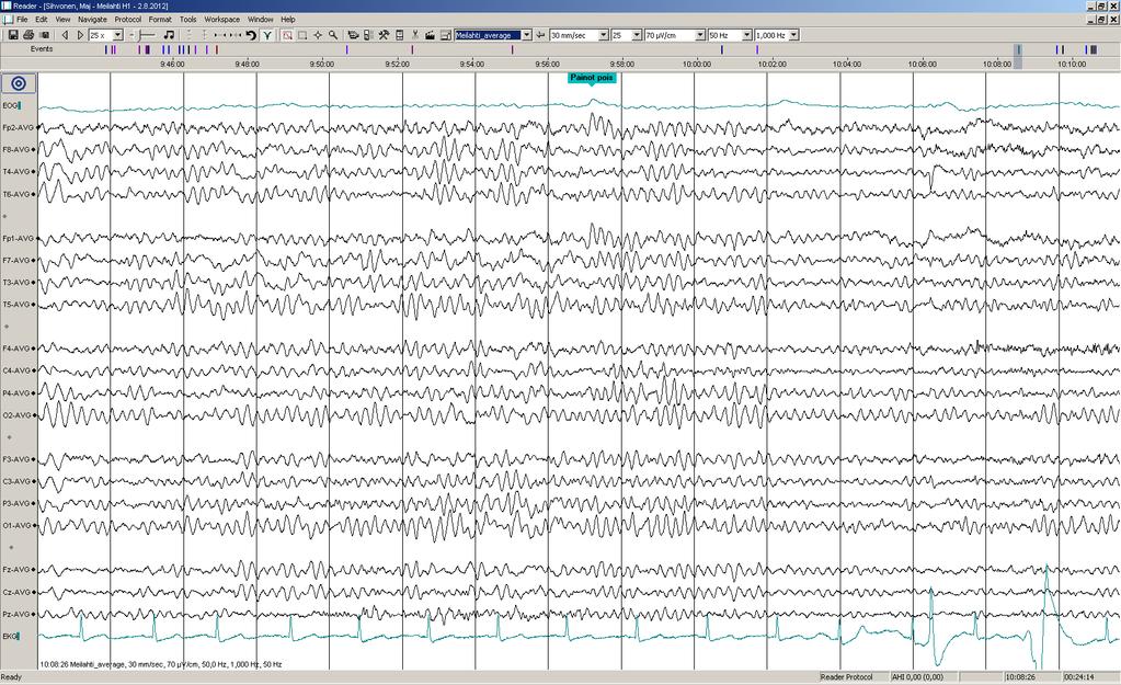 Päiv-EEG-ilmiöitä 10/17:.