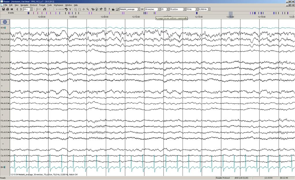 Päiv-EEG-ilmiöitä 13/17:.