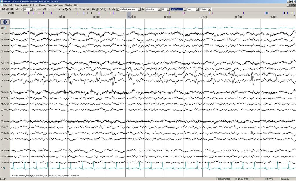 Päiv-EEG-ilmiöitä 17/17: