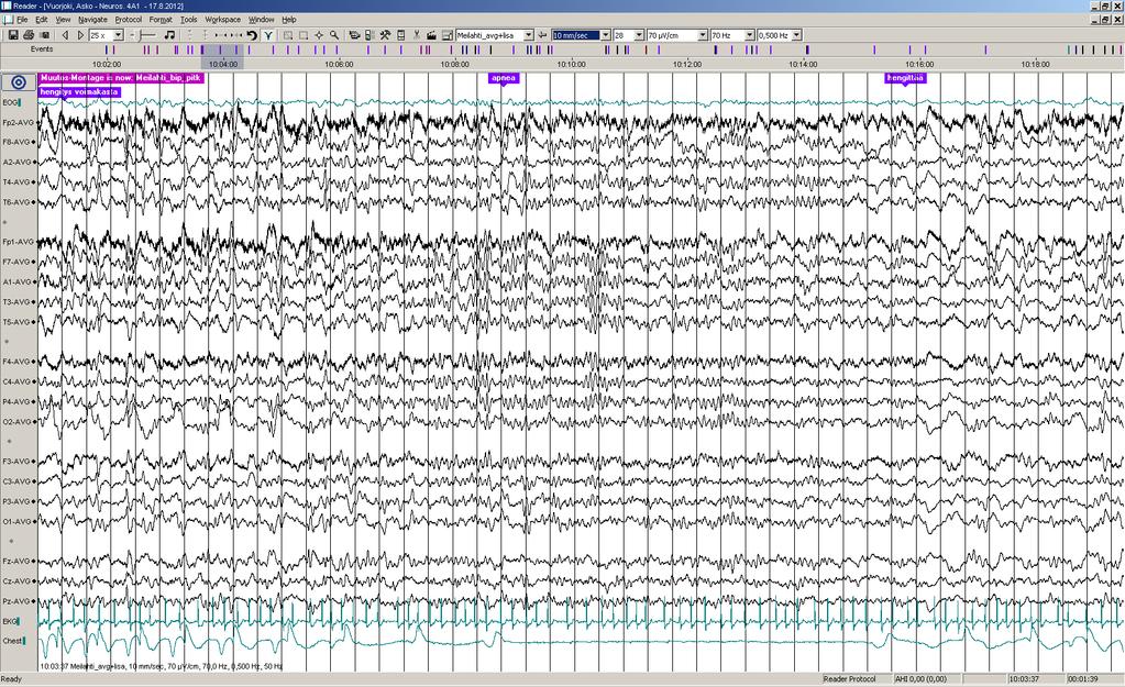 Päiv-EEG-ilmiöitä 2/17: Chestissä varmistus