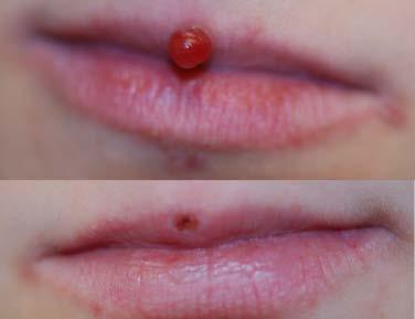 Comparative evaluation of long-pulse alexandrite and long-pulse Nd:YAG laser systems used individually and in combination for axillary hair removal. Dermatol Surg 2008;34:665 71.