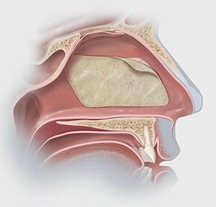 Kollageenipitoinen aines erotellaan submucosasta (Extracellular matrix, ECM), joka on rakenteeltaan hyvin avoin.