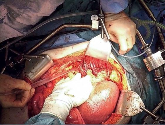 Kuva 1. Maksan mobilisaation jälkeen oikeanpuoleisen palleakaaren vatsakalvo on poistettu. määrin levinneen munasarjasyövän leikkaushoitoon eli niin sanottuun ultraradikaalikirurgiaan.