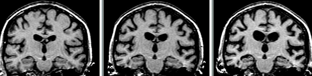 Alzheimerin tauti ja aivojen kuvantaminen