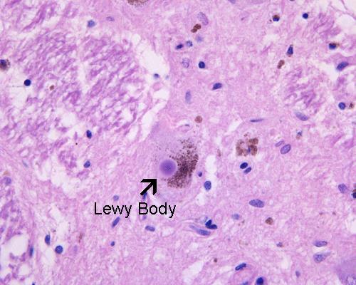 Lewyn kappale patologiaan liittyvät sairaudet Saaneet nimensä aivoissa havaittavien löydösten, Lewyn kappaleiden, kertymisestä aivoihin Lewyn kappale -tauti: tiedonkäsittelyn toimintojen,