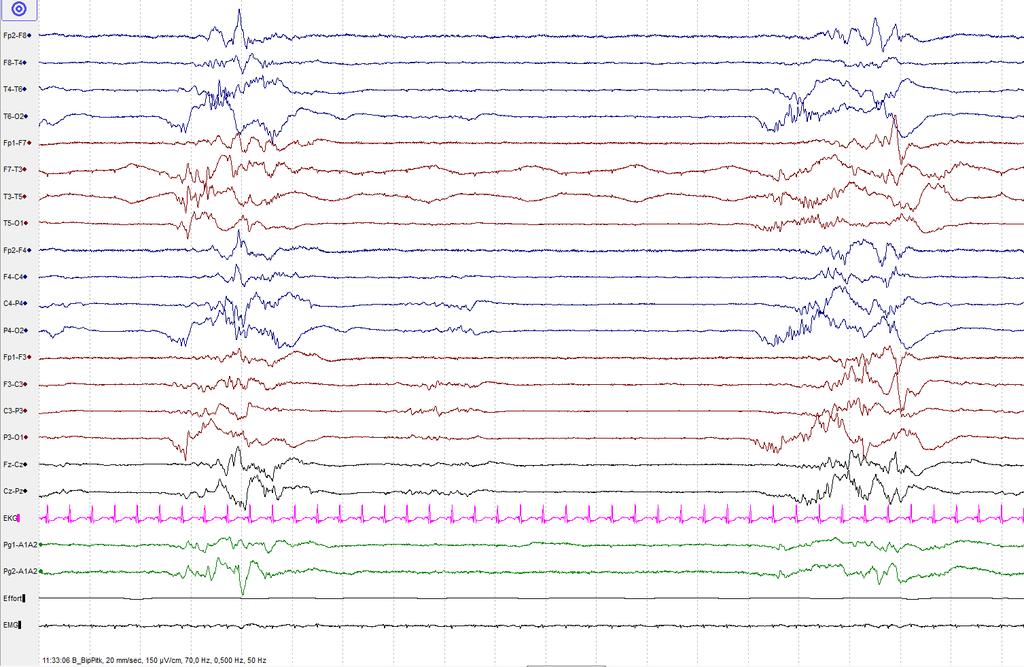 EEG:n perusteella voi päätellä vauvan iän 2 viikon tarkkuuden Eri kehitysvaiheiden löydökset: