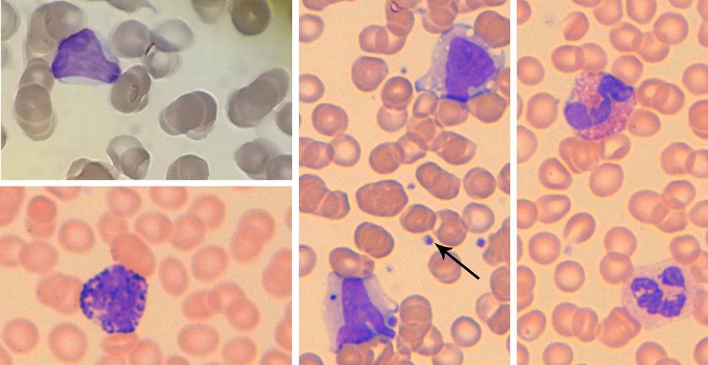 KUVA 23. Valkosoluja veren sivelyvalmisteessa. Vasemmalla ylhäällä lymfosyytti ja alhaalla basofiili. Keskellä kaksi monosyyttiä ja nuoli osoittaa verihiutaletta.