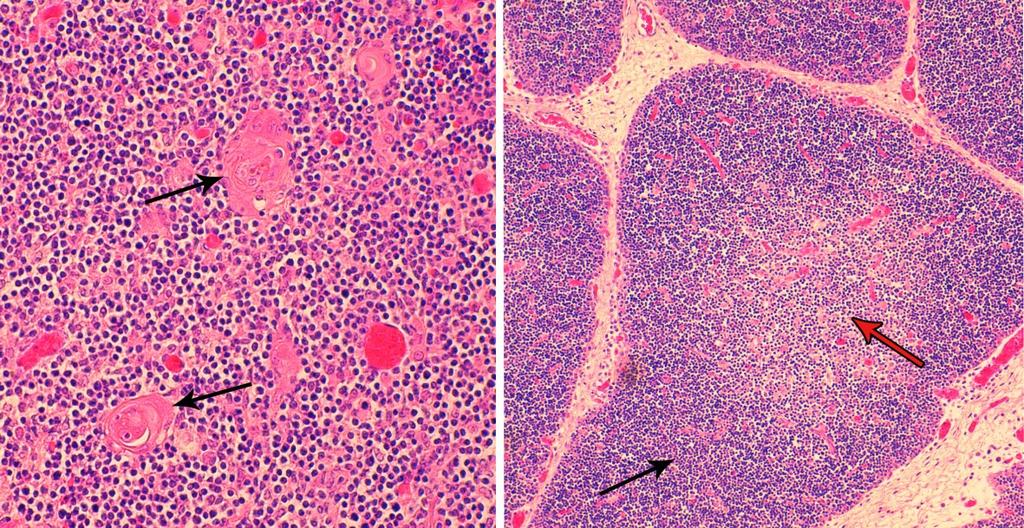 korteksiin. Kypsyttyään solut vapautuvat medullan kautta takaisin verenkiertoon ja siirtyvät toissijaisiin lymfaattisiin kudoksiin ja elimiin. (Ovalle & Nahirney 2008, 205-206, 208.) KUVA 26.