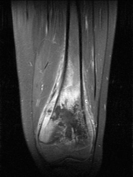 Röntgenkuvassa tuberositas tibiae on usein