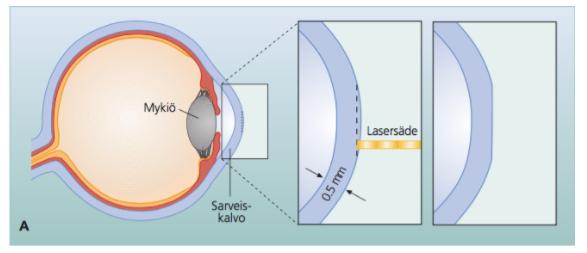 16 4.1 PRK (Photorefractive Keratectomy) PRK-leikkausmenetelmässä sarveiskalvon epiteeli poistetaan joko mekaanisesti, alkoholilla tai laserilla (Transepithelial photorefractive keratectomy, T-PRK).