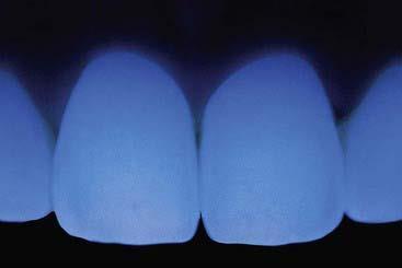 33 Korkean lasipitoisuuden sisältävät hammaskeraamit ovat läpikuultavia.