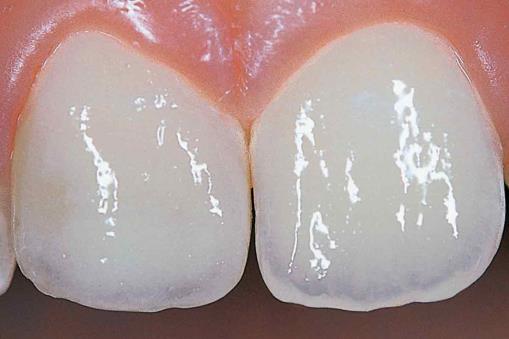 34 Hampaassa kiille fluoresoi hyvin vähäisesti ja pääosa fluoresoinnista tapahtuu dentiinissä.