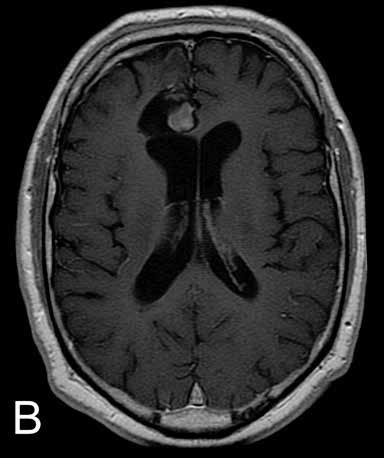 Kuva 2. Primaarista aivolymfoomaa sairastaneen 44-vuotiaan potilaan (taulukko) MK-kuvia (T1- painotteinen, merkkiainetehosteinen).