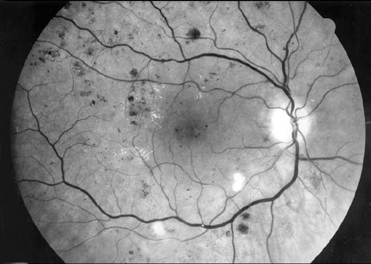 Proliferatiivinen retinopatia, makulaturvotus.