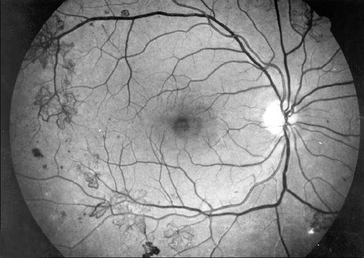 Proliferatiivinen retinopatia Uudissuonet ovat hauraita ja voivat vuotaa
