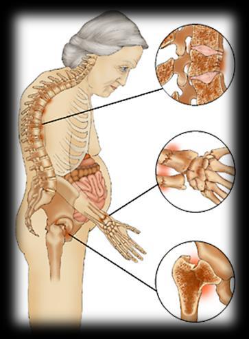 Luustoinfo -ryhmä Luustohoitaja + ft Ryhmämuotoinen ensitietopaketti 1 x 3h Tavoite: osteopenia-/osteoporoosi dg:n saaneille tietoa, taitoa, tukea omahoitoon Luennoitsijoina luustohoitaja ja