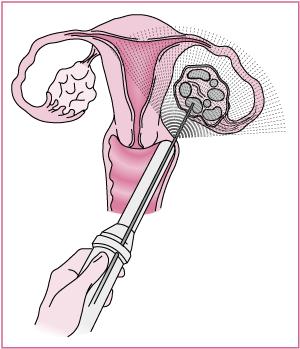 IVF-hoito lyhyesti Hormonilääkityksen avulla stimuloidaan munasarjoja, jotta useita munasoluja (5-15) saadaan kypsymään samanaikaisesti.