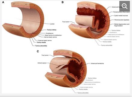 Aortan dissekaatio Sydäninfarkti raskauden aikana 6.