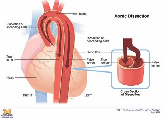 sydänsairaus (ateroskleroosi) Koronaarispasmi SCAD (spontaneous coronary artery dissection)